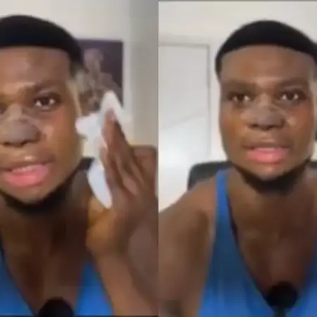 Zicsaloma shares video after his 3-week nose surgery, narrates why he did it